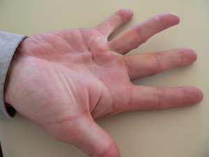 Dupytren's Contracture (Disease) Corrective Hand Surgery - Gerald L. Yospur - Mesa, AZ